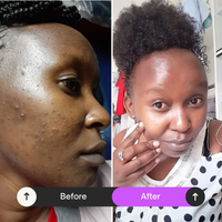 Teen Acne Clearance Pack