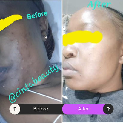 Teen Acne Clearance Pack